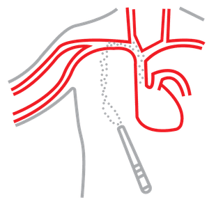 Vascular Access